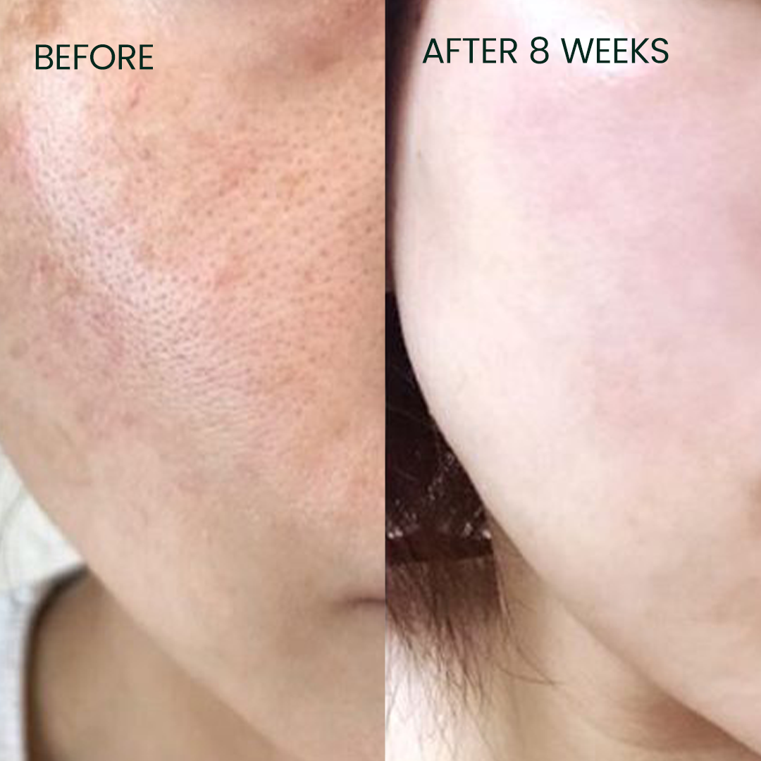 Before and After results of using Vitamin C Serum