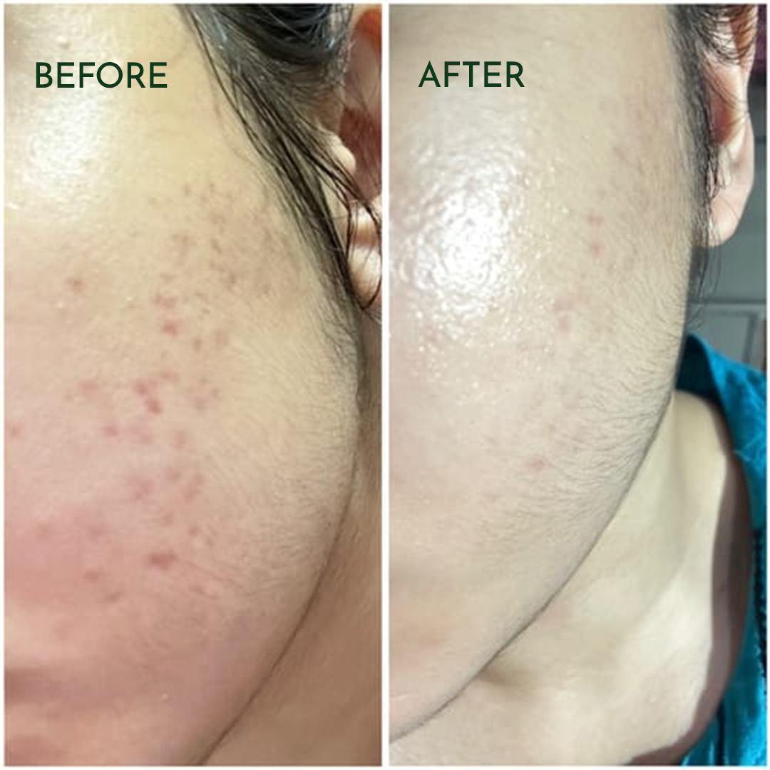 Before and after picture by using Acne clarifying serum
