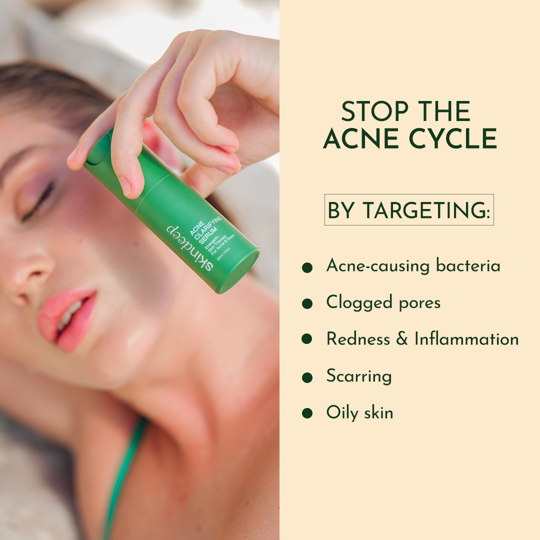 "Skindeep Acne Clarifying Serum to stop acne cycle and prevent breakouts"
