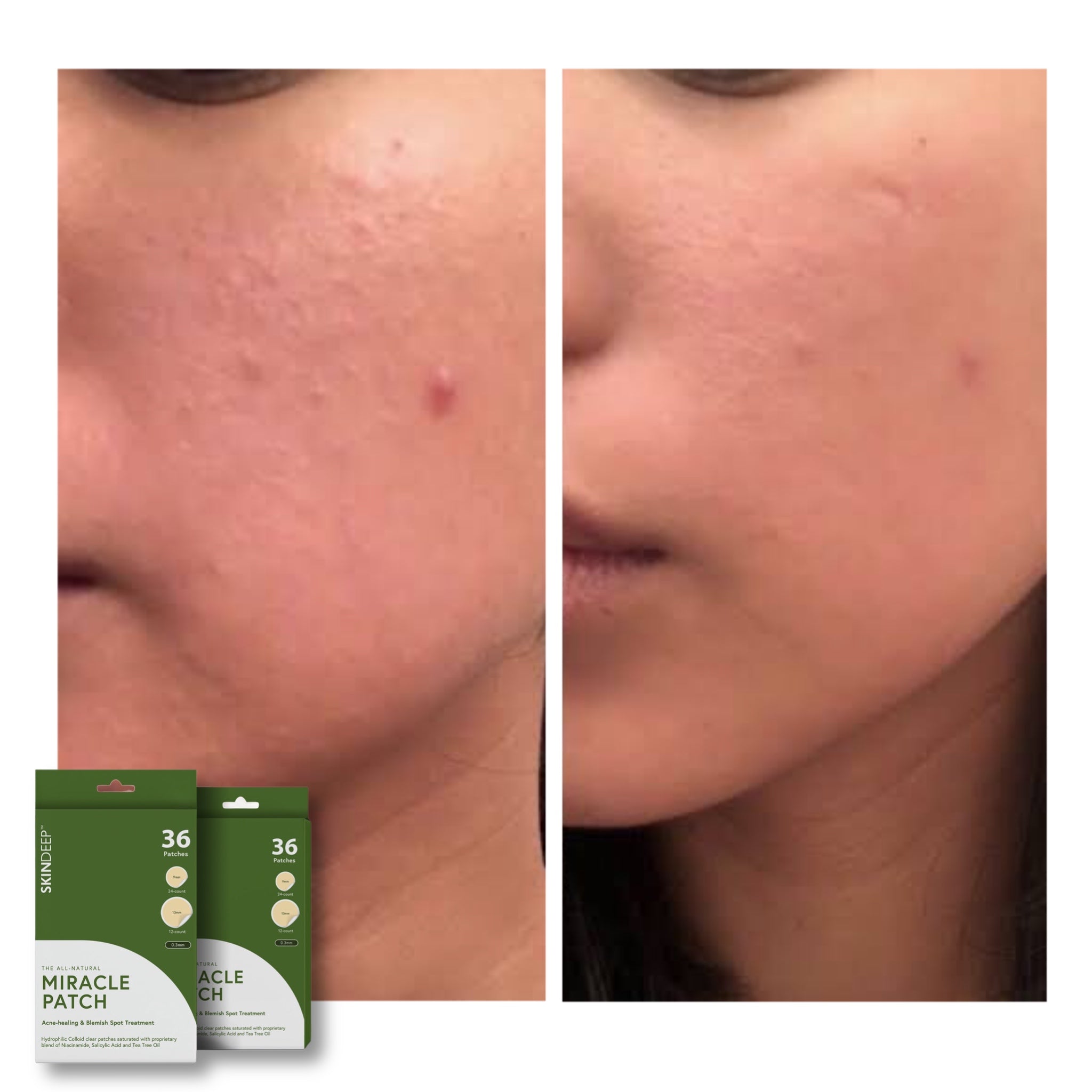 MIRACLE PATCH - Acne Healing & Blemish Spot Treatment