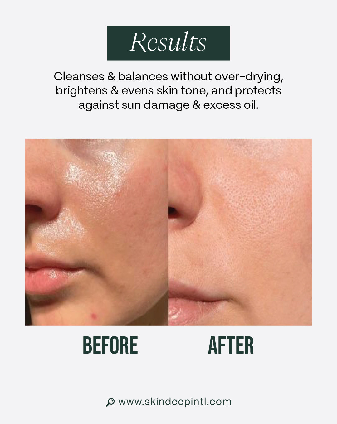 Balanced Skin Bundle — Routine For Oily Skin