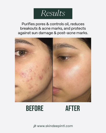 Blemish-Free Bundle — Routine For Acne-Prone Skin