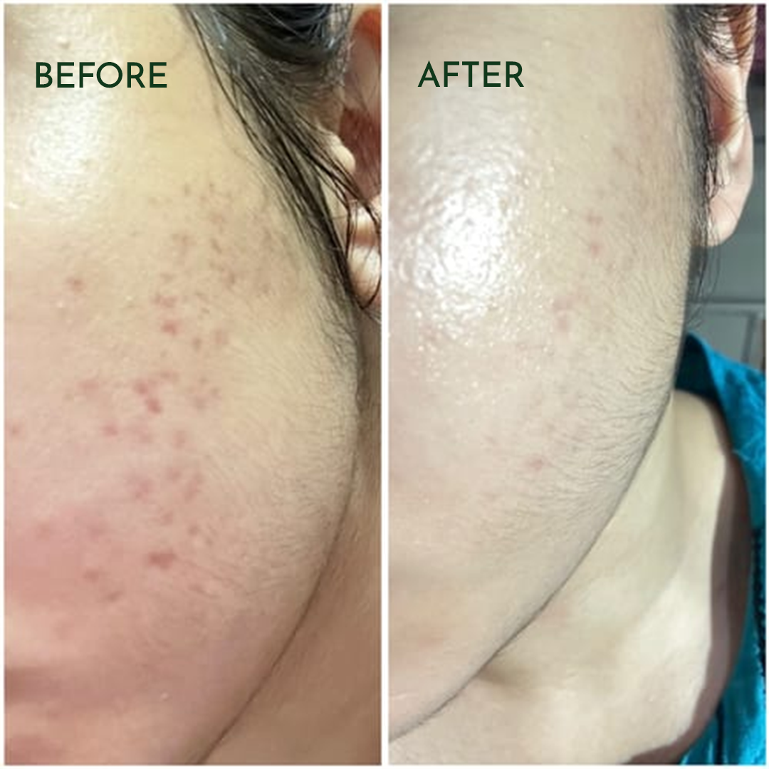 ACNE CLARIFYING SERUM - Energetic Skin Therapy for Acne & Scars